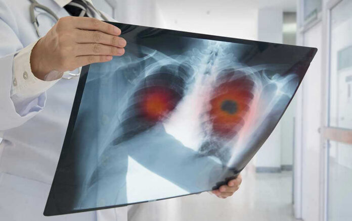 626631452 Doctor holding lung Xray with highlighted areas