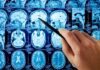 A hand pointing at MRI brain scans displayed on a screen