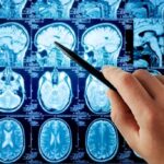 A hand pointing at MRI brain scans displayed on a screen