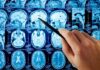 Terrifying Brain Mold Spikes In U.S. Hand pointing at brain MRI scans with a pen